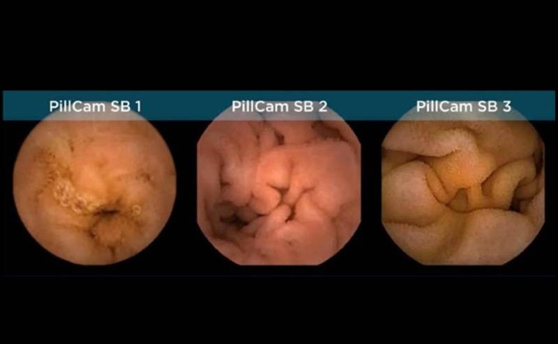 A evolução da imagem gerada pela PillCam. (Fonte: Medtronic/Reprodução)