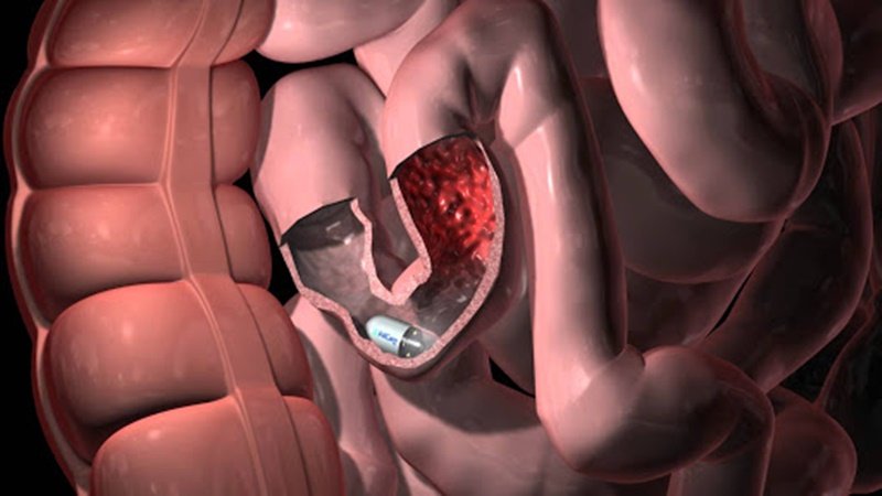 A PillCam atua dentro do intestino delgado, órgão com mais de cinco metros de comprimento. (Fonte: Medtronic/Reprodução)