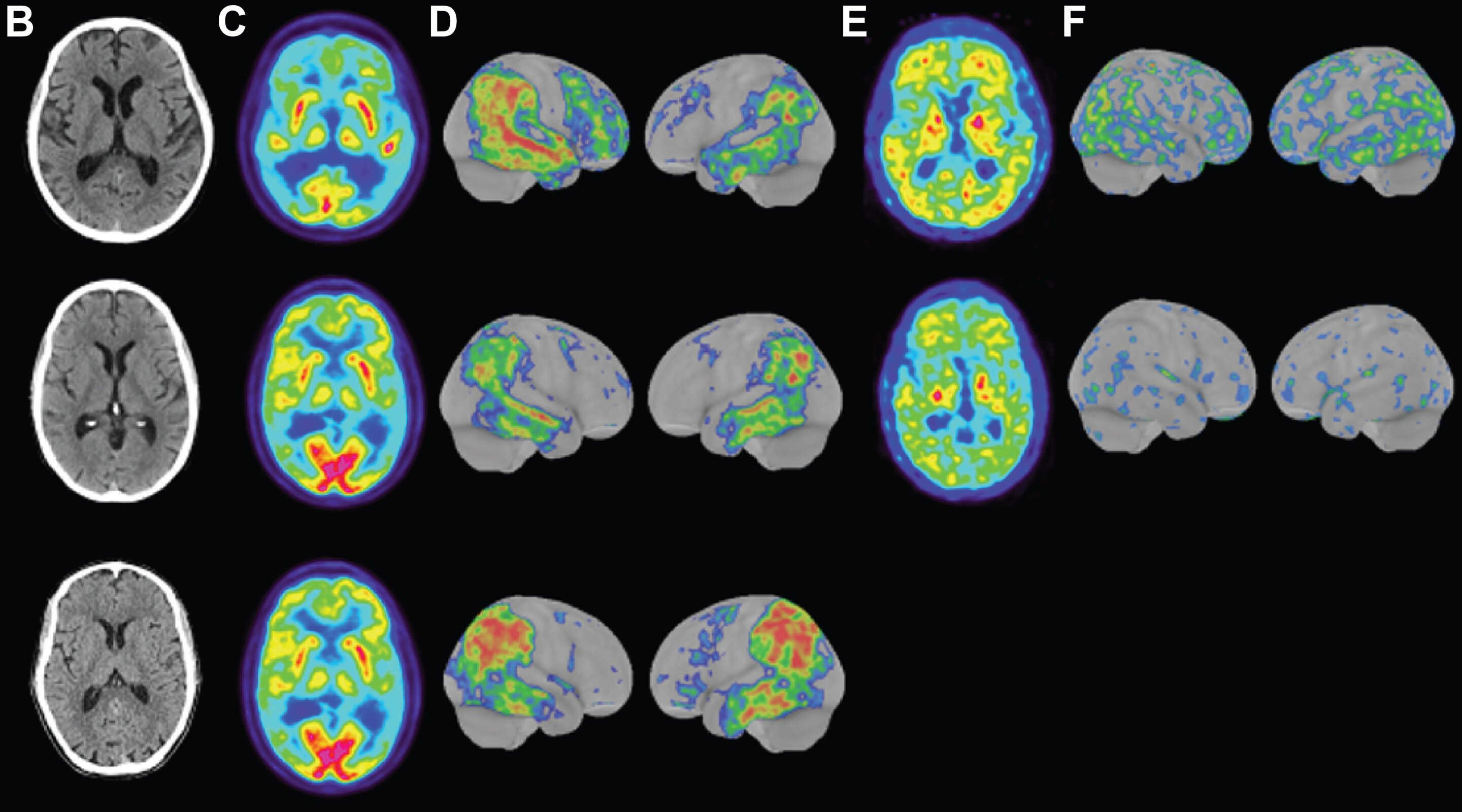 Imagens dos cérebros dos três portadores da forma de Alzheimer precoce
