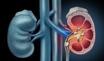 Cientistas usam conhecimentos de geologia para tratar cálculos renais