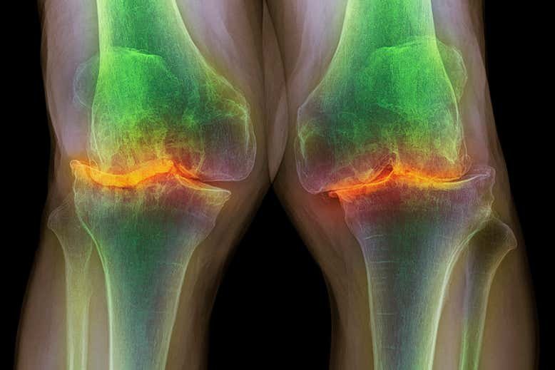 Radiografia dos joelhos de um homem de 87 anos com osteoartrite grave.