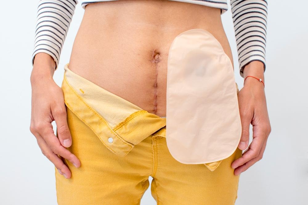 Doença de Crohn é uma inflamação no trato gastrointestinal que, em casos graves, pode levar ao uso da bolsa de colostomia (Fonte: Shutterstock/Reprodução)