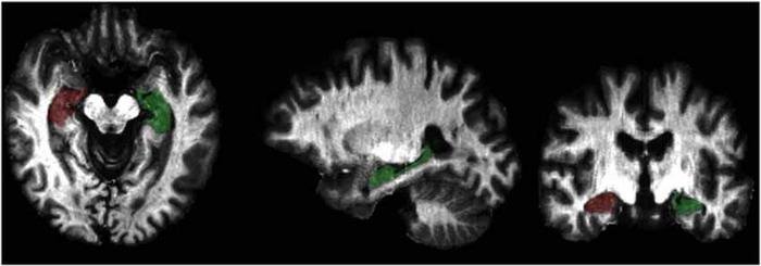 Ressonâncias magnéticas realizadas em veteranos com TEPT mostrou um aumento da mielina em áreas específicas do cérebro