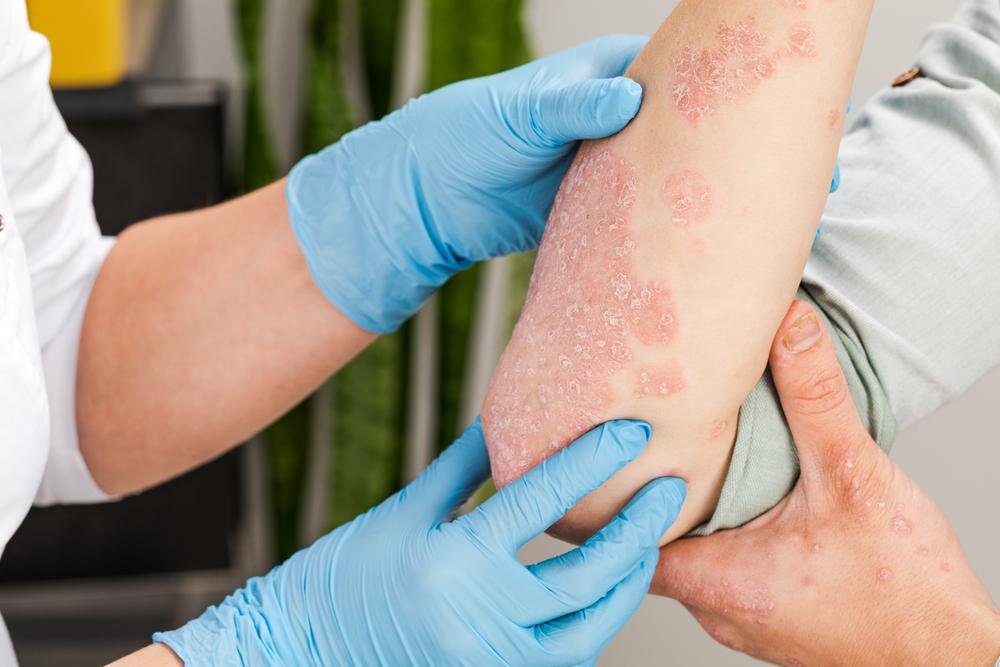 A dermatite é um problema de pele característico pelo surgimento de vermelhidões (Fonte: Shutterstock)