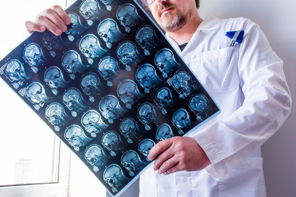 Exames de imagem ajudam a fazer o diagnóstico da esclerose múltipla