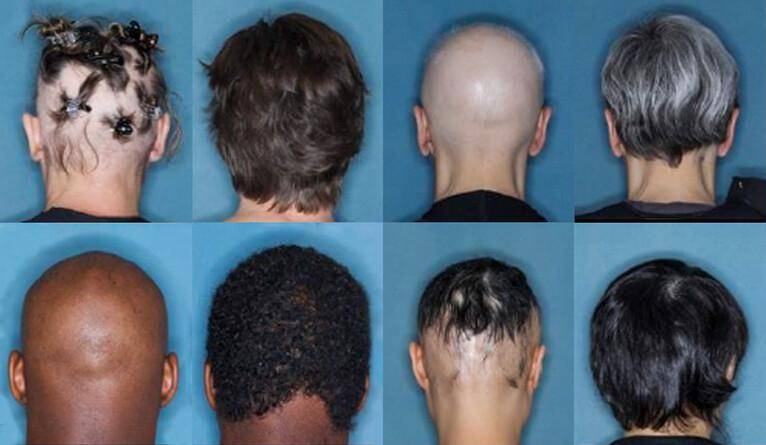 Antes e depois dos pacientes que receberam 36 meses de tratamento com baricitinibe (Fonte: Universidade de Yale/reprodução)