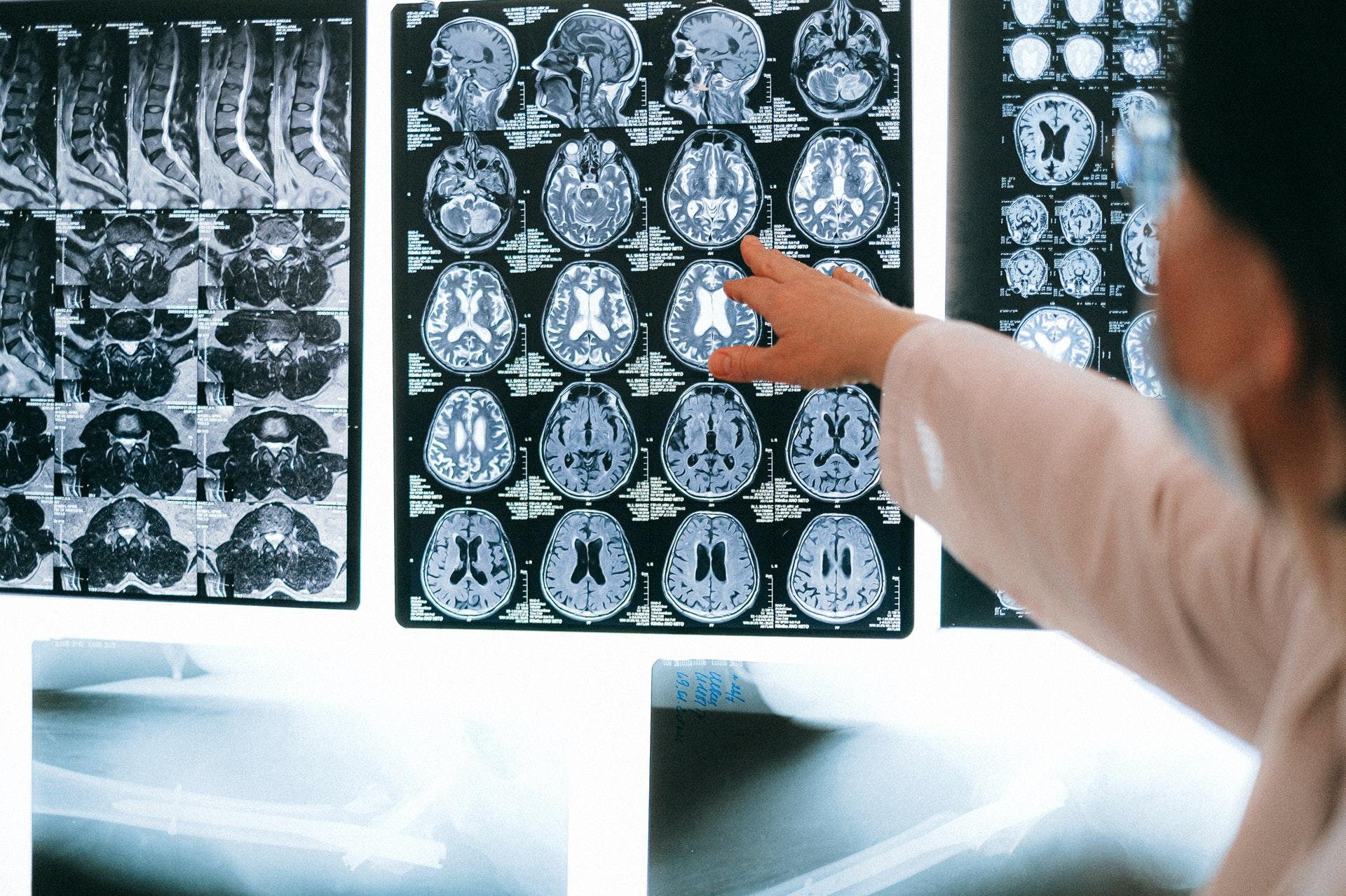Esclerose múltipla é uma doença autoimune que afeta o sistema nervoso (Fonte: Pexels/Anna Shvets)
