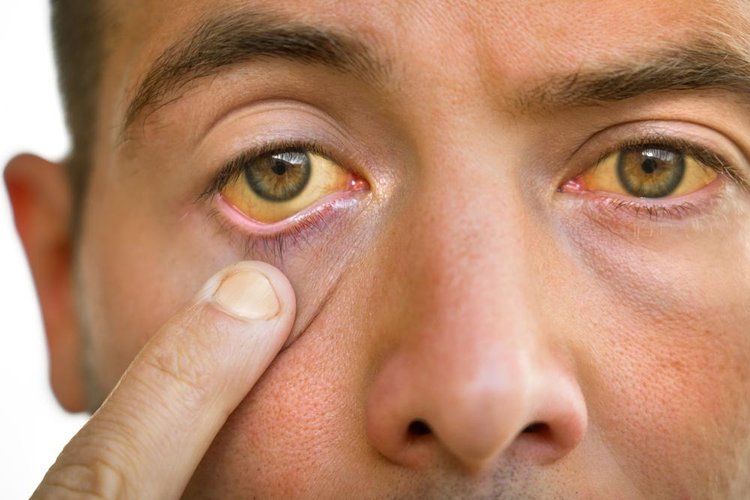 Os sintomas da hepatite incluem náusea, pele e olhos amarelados, febre, dor abdominal, entre outros