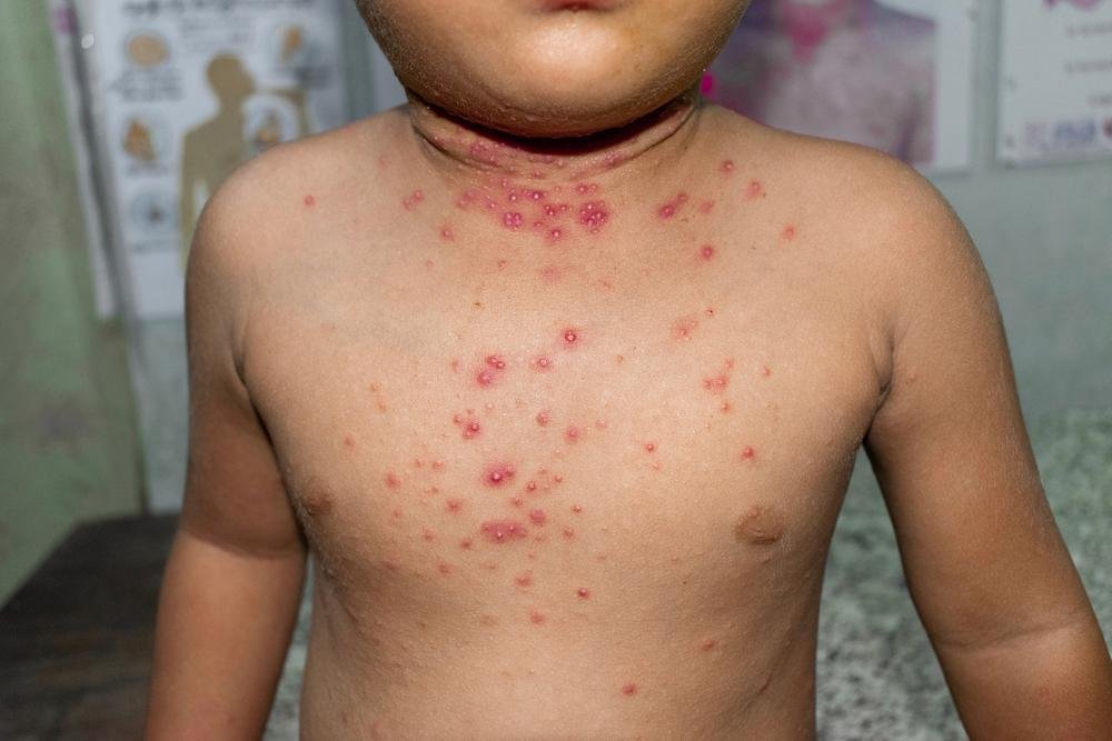 Doença é similar à varíola humana (Fonte: Shutterstock)