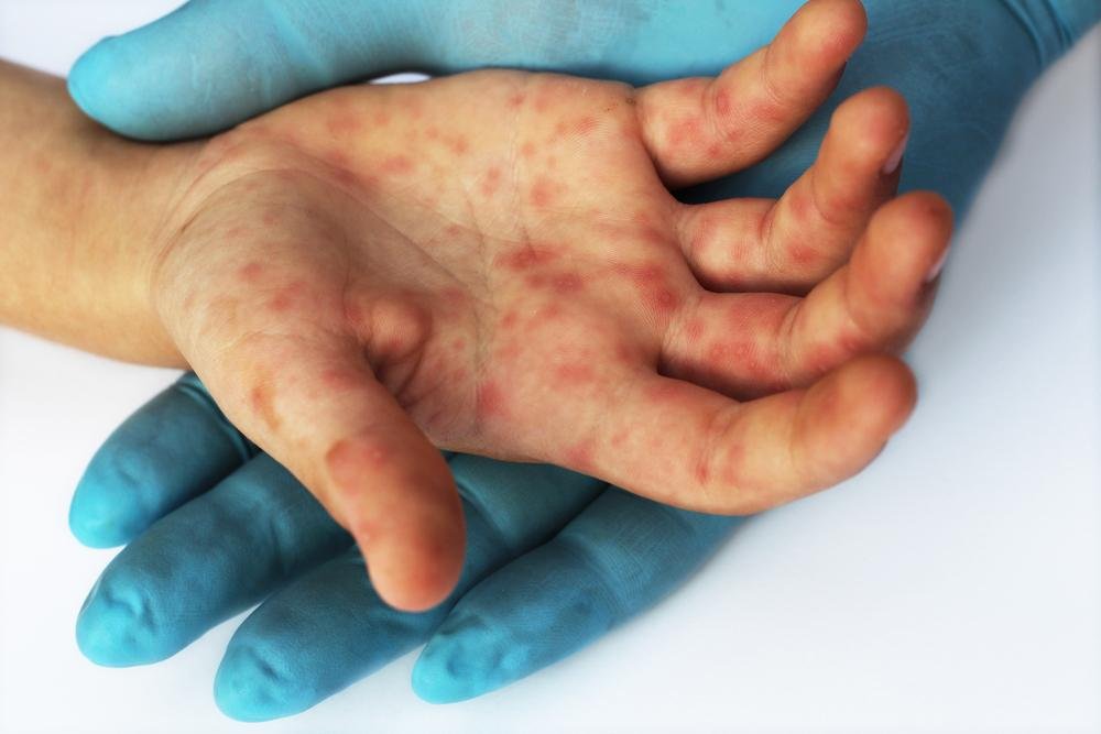Pacientes infectados devem buscar tratamento (Fonte: Shutterstock)