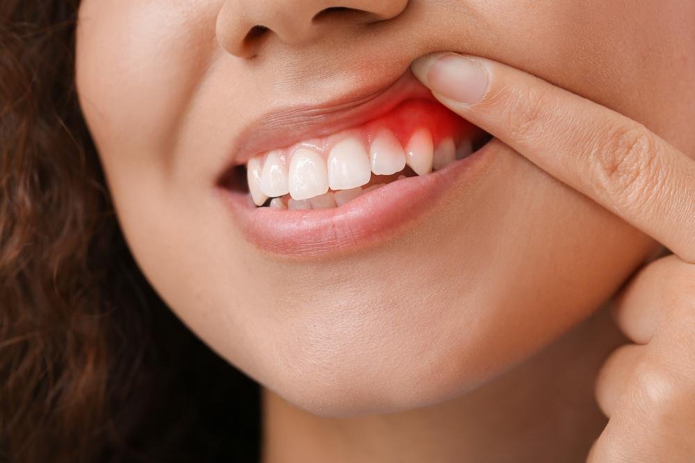 A periodontite se caracteriza pela vermelhidão da gengiva (Fonte: Shutterstock)