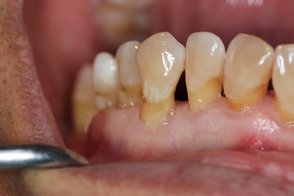Hábitos alimentares ruins estão entre as causas da periodontite (Fonte: Shutterstock)