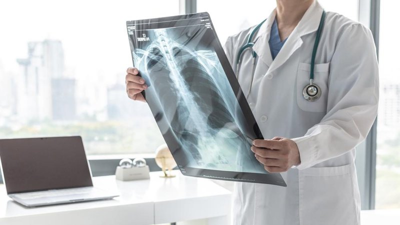 Em 2020, foram diagnosticados mais 2,21 milhões de casos de câncer de pulmão