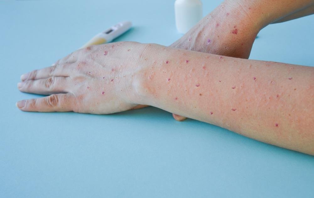 Lesões na pele estão entre os sintomas da varíola de macacos