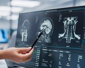 Método consegue detectar Alzheimer com apenas uma ressonância magnética