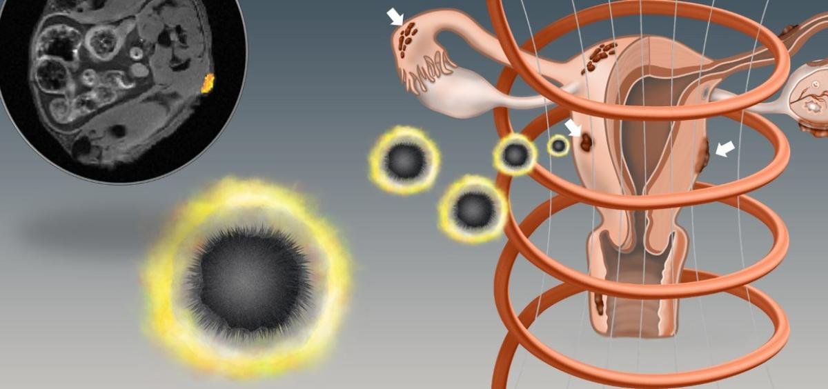 Ilustração das nanopartículas no útero; até o momento, o estudo foi realizado apenas em ratos