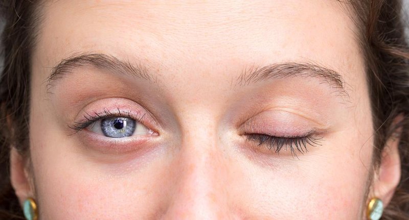 Casos de espasmo hemifacial afetam apenas um lado do rosto (Fonte: Shutterstock)
