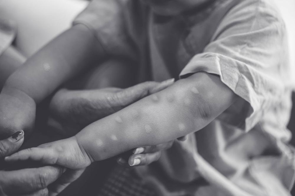 Dois casos de varíola de macaco foram registrados em crianças nos Estados Unidos (Fonte: Shutterstock)