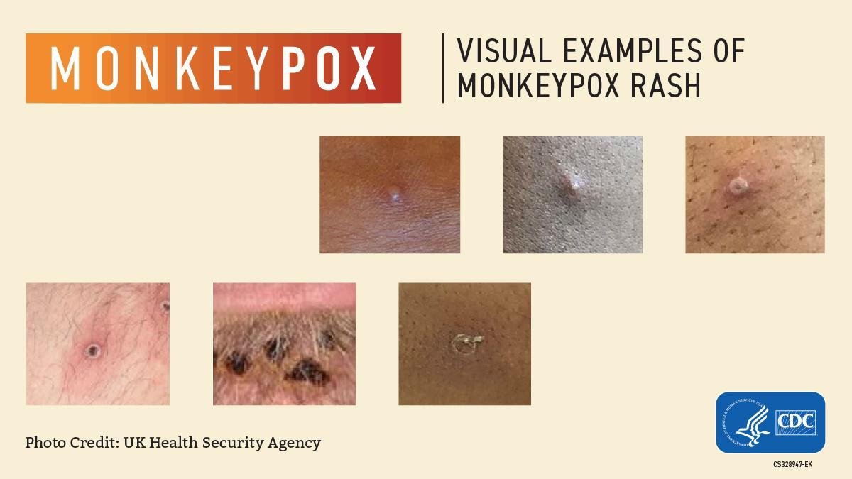 Imagem mostra exemplos de erupções cutâneas causadas pelo vírus da varíola dos macacos