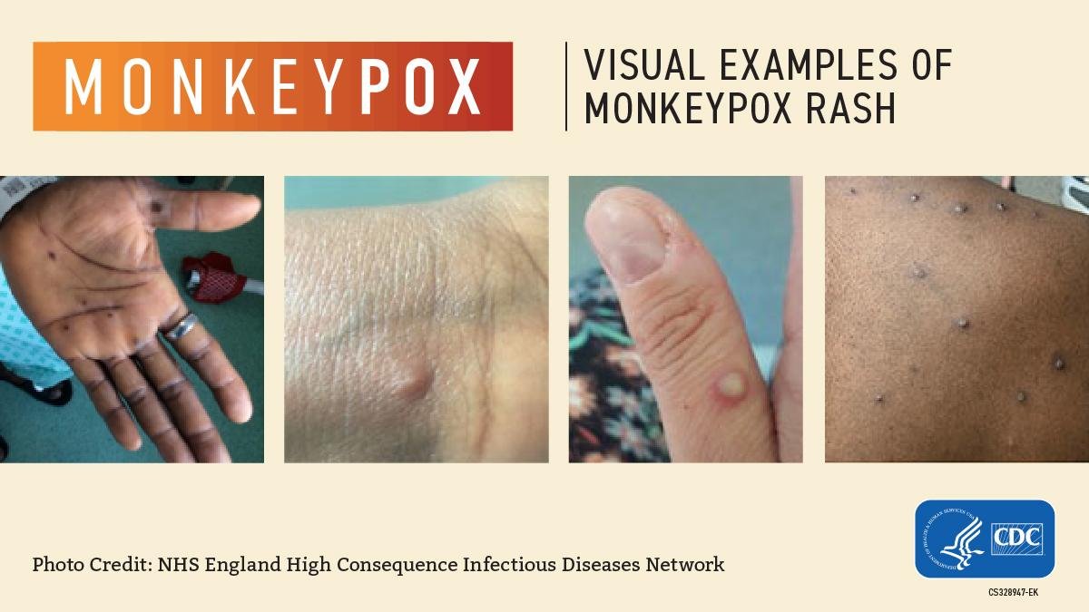 Imagem mostra exmplos de feridas causadas pela varíola dos macacos