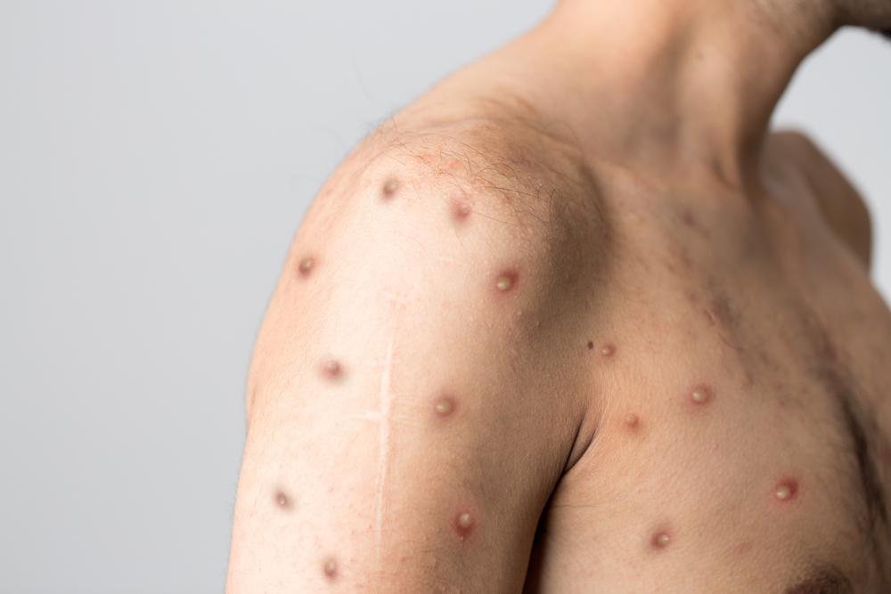Lesões na pele estão entre as principais características da varíola de macacos