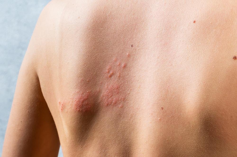 A falta de vitamina favorece o surgimento de lesões na pele (Fonte: Shutterstock)