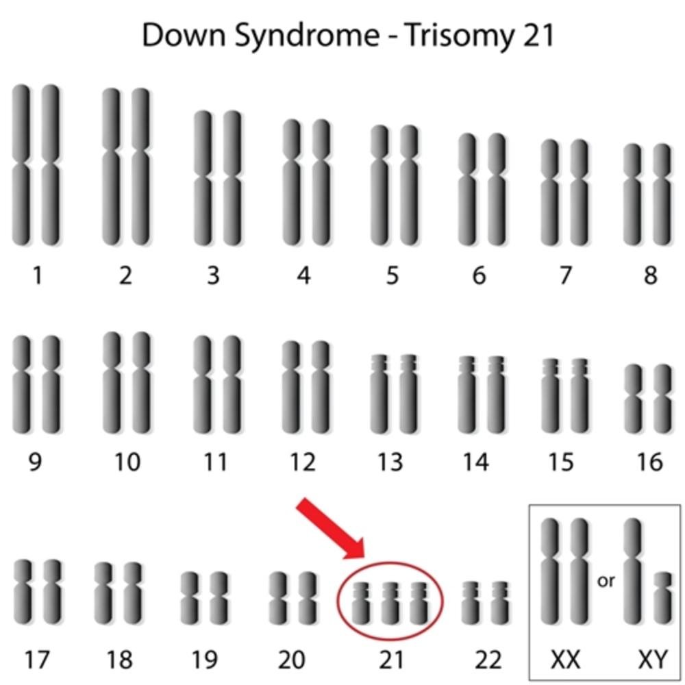 O cromossomo extra pode ser doado tanto pelo gameta feminino, quanto o masculino.