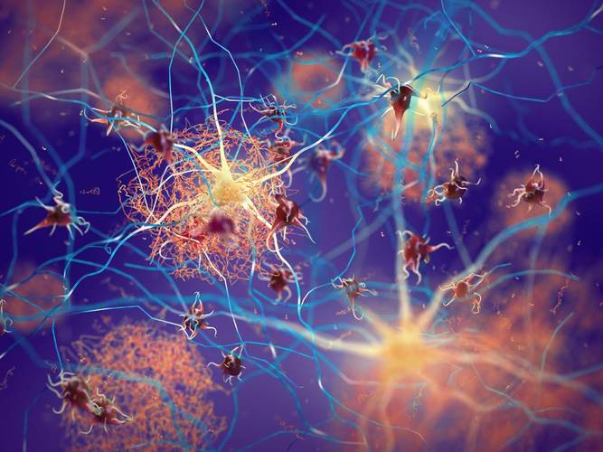 Graças a ação errônea dessas duas proteínas, os neurônios morrem, e com isso, os sintomas característicos e progressivos do Alzheimer se iniciam.