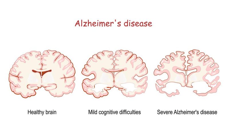 A progressão da doença causa danos irreparáveis no cérebro