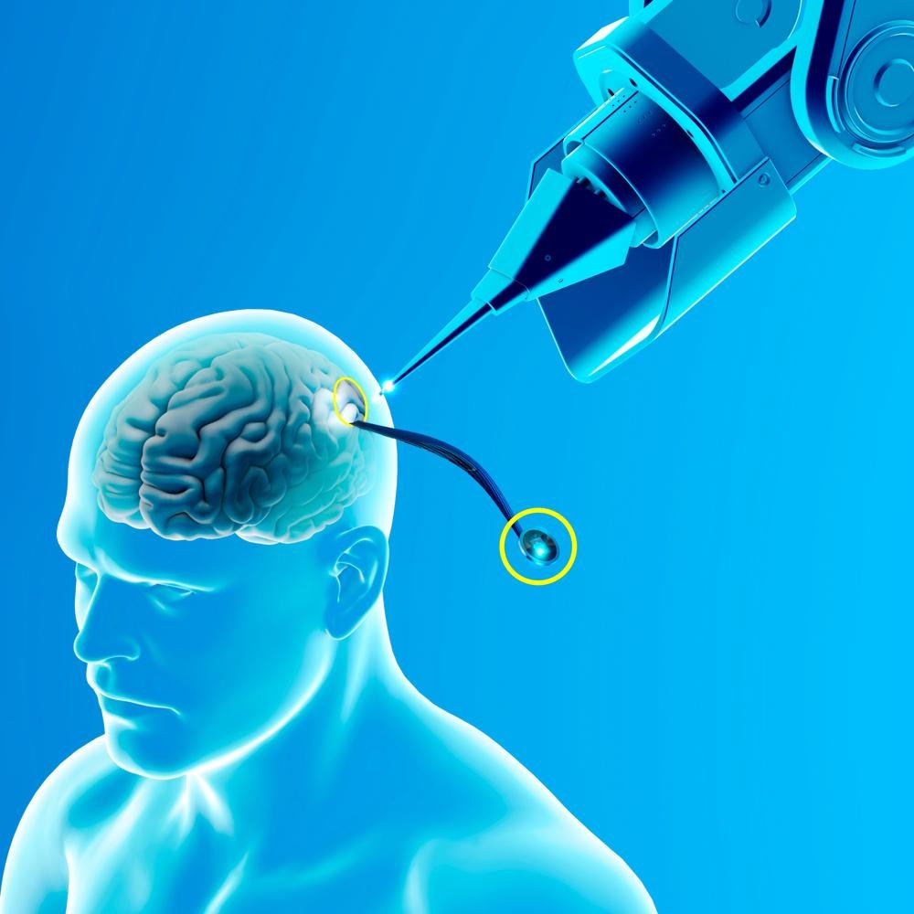Inicialmente, o implante cerebral deve ajudar pessoas com paralisia.