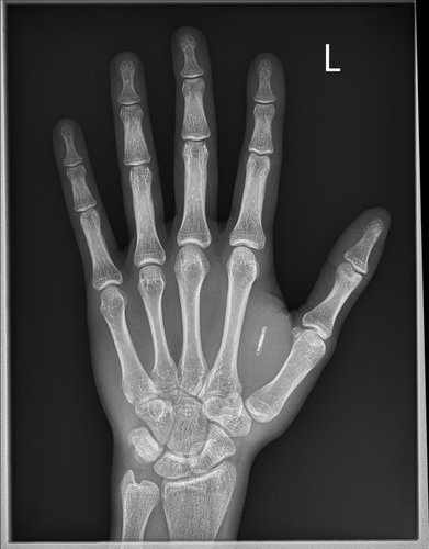 Implantados entre o polegar e o indicador, os biochips de radiofrequência estão entre os mais populares (Fonte: Wikimedia Commons/WCusr2019)