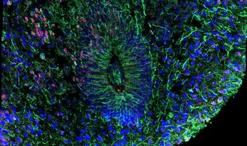 Cientistas criam minicérebros usando células de pessoas com esquizofrenia