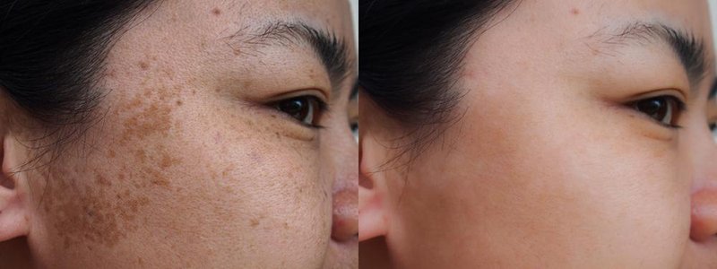 O tratamento ou procedimento inadequado pode agravar as manchas de pessoas com melasma.