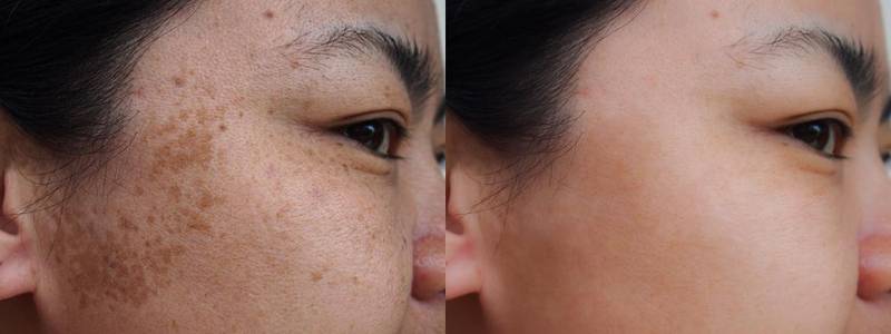 O tratamento ou procedimento inadequado pode agravar as manchas de pessoas com melasma.