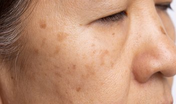 O que é melasma e como evitar o surgimento das manchas?