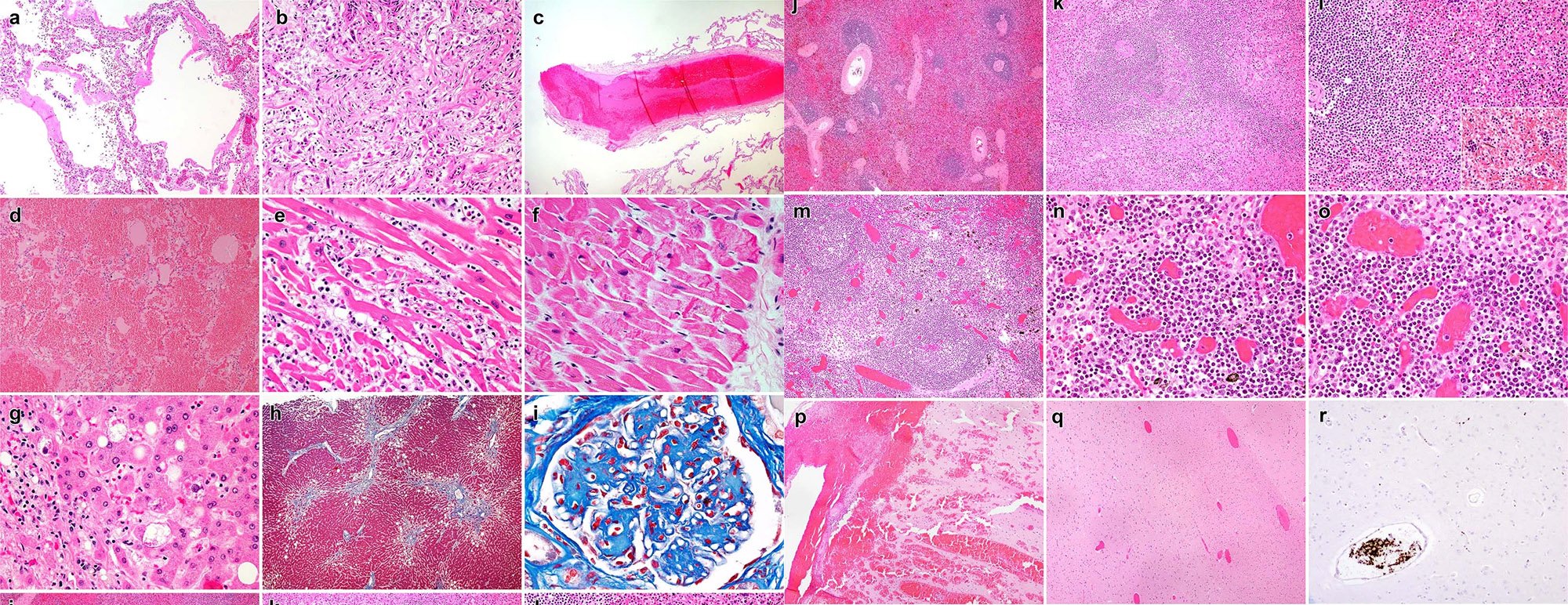 Diagnósticos histopatológicos de autópsias de pacientes com o vírus da covid-19 em diversos órgãos. (Fonte: Stein et al./Divulgação.)