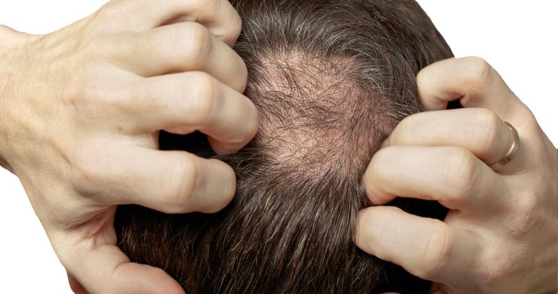 A queda de cabelo é um problema comum em mulheres e homens de todo o mundo.