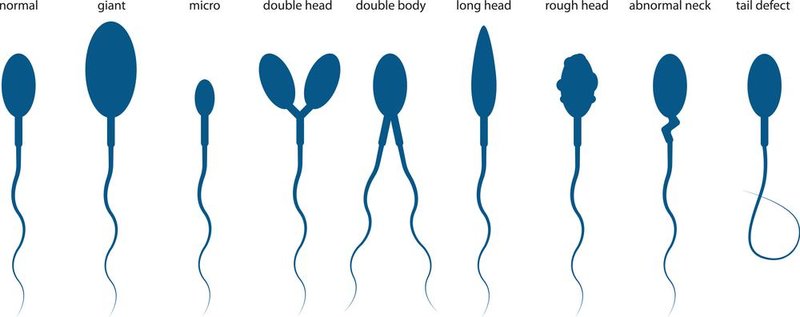 Além da produção de espermatozoides anômalos, alguns homens também podem ter baixa produção dos gametas.