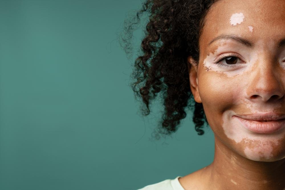 O Vitiligo é uma doença autoimune caracterizada pela destruição do pigmento melanina, presente na pele.
