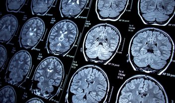 Atividade cerebral pode indicar tendência para o estresse pós-traumático