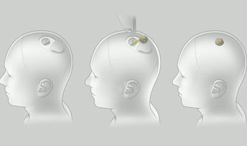 Neuralink de Elon Musk é investigada por transporte de patógenos perigosos