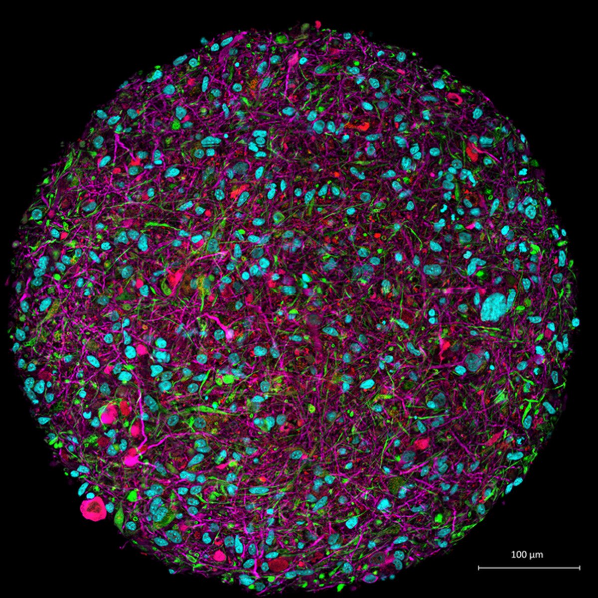 Imagem ampliada de um organoide cerebral cultivado em laboratório com um marcador florescente indicando os diferentes tipos de células; em rosa, os neurônios; os oligodendrócitos em vermelho; os astrócitos em verde; núcleos de células em azul