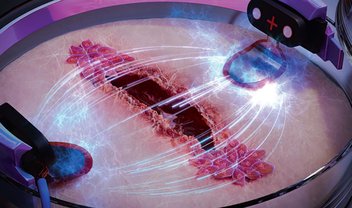Estímulo elétrico acelera cicatrização de feridas crônicas