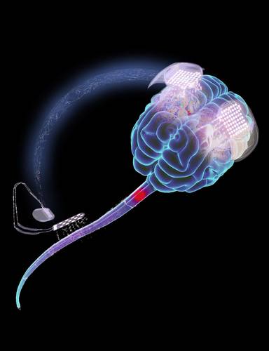 Os eletrodos no cérebro capta ativação cerebral e enviam um sinal para os eletrodos na medula.