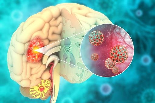 O método quântico pulveriza um spray de bionanoantenas; os pesquisadores afirmam que a técnica é capaz de curar o glioblastoma, um tipo de câncer cerebral.