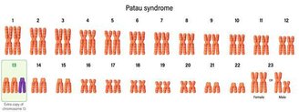 Na Síndrome de Patau, por exemplo, há um cromossomo extra na posição 13, formando uma trinca.