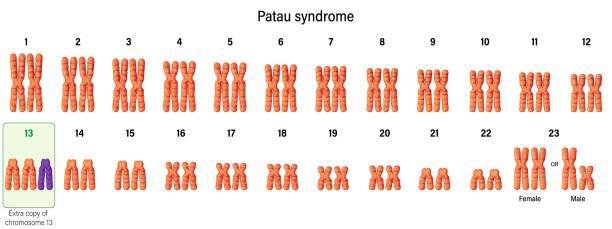 Na Síndrome de Patau, por exemplo, há um cromossomo extra na posição 13, formando uma trinca.