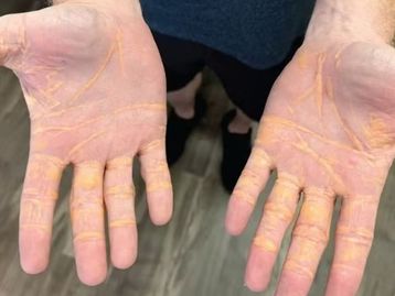 Xantelasma: entenda o quadro que cria nódulos de gordura no corpo por excesso de colesterol
