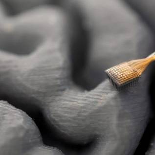 Imagem de Paciente com doença neurológica volta a 'falar' após implante de chip cerebral