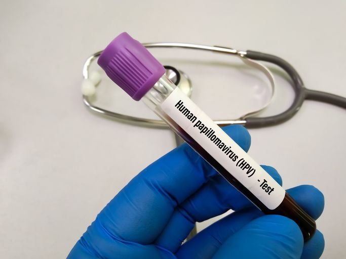 Novo exame gratuito para detectar vírus do HPV já está disponível no SUS Um novo exame para detectar o papilomavírus humano (HPV), principal causador do câncer de colo de útero, começou a ser oferecido gratuitamente nas unidades do Sistema Único de Saúde (SUS) de vários estados, este mês. O método vai substituir gradativamente o papanicolau, em todo o Brasil, segundo o Ministério da Saúde. teste-de-laboratorio-hpv